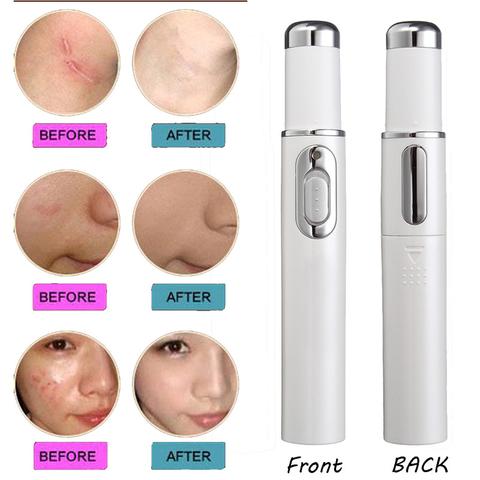 MOQ1  Wrinkle Blemish Pore Acne Scar Remover Pen